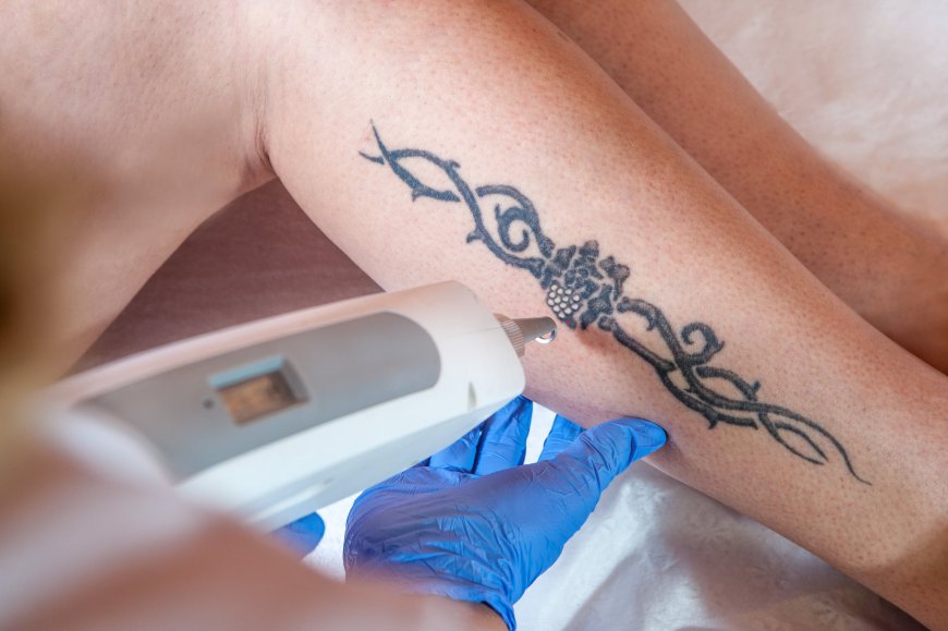 What Makes a Laser Tattoo Easy to Remove in Dubai