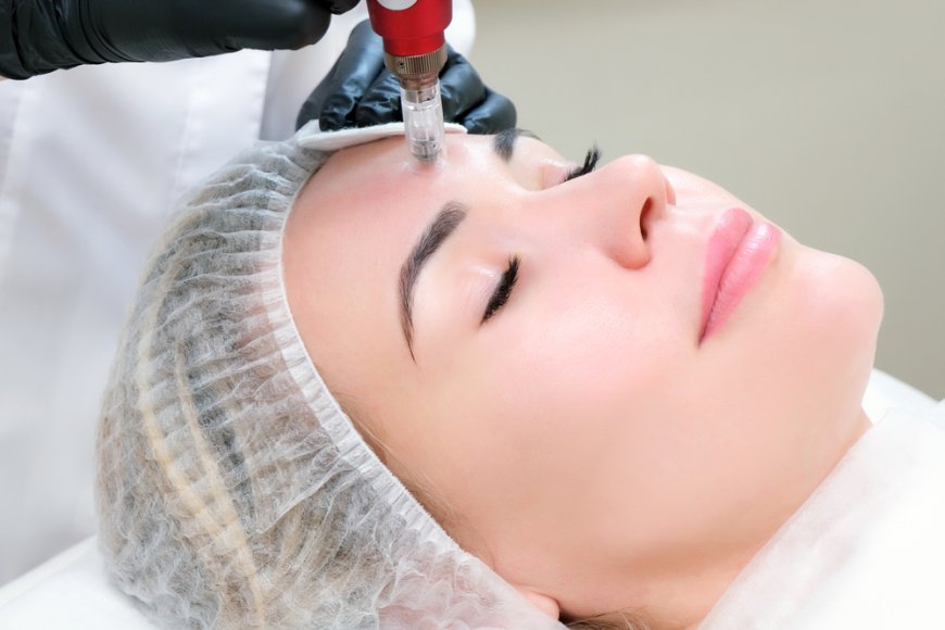 Can I do microneedling at home?