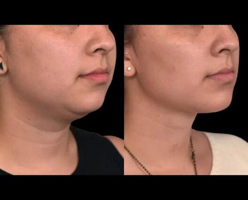 Double Chin Removal Surgery in Dubai: Real Patient Testimonials