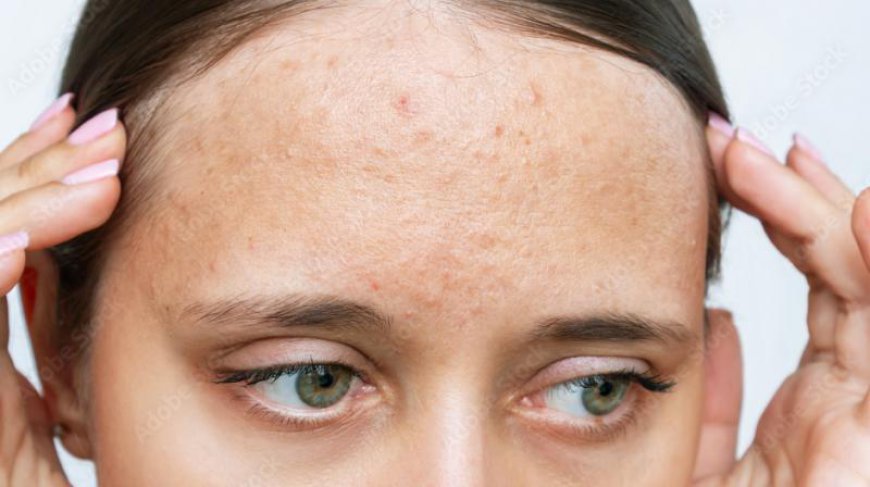 The Best Pimples Treatment for Oily Skin