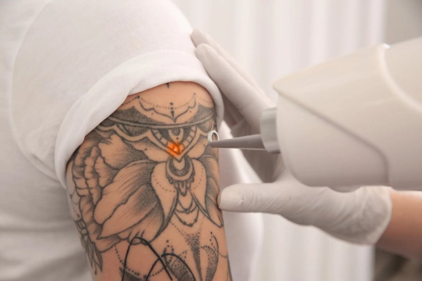 Is Laser Tattoo Removal Permanent: Understanding Lasting Results in Dubai