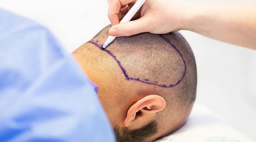 How to Care for Your Hair After a Transplant