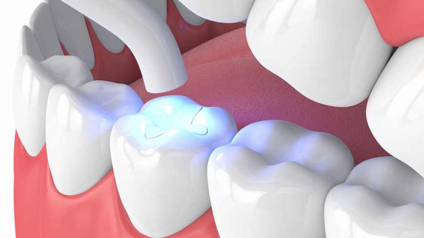 How Long Will Dental Fillings Last ?