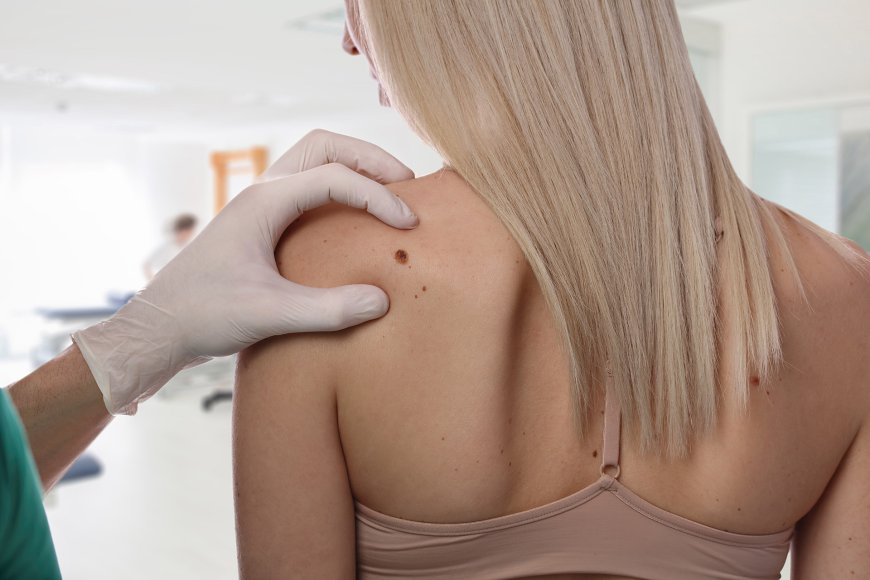 Pain-Free Mole Removal: What to Expect