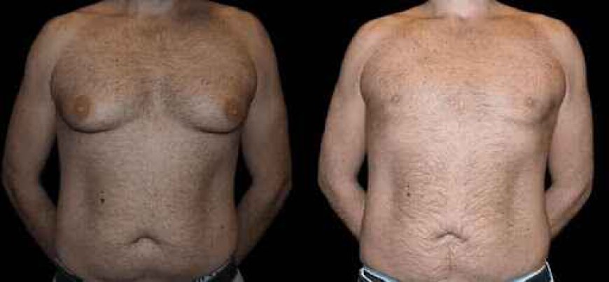 Understanding the Gynecomastia Treatment Process in Dubai