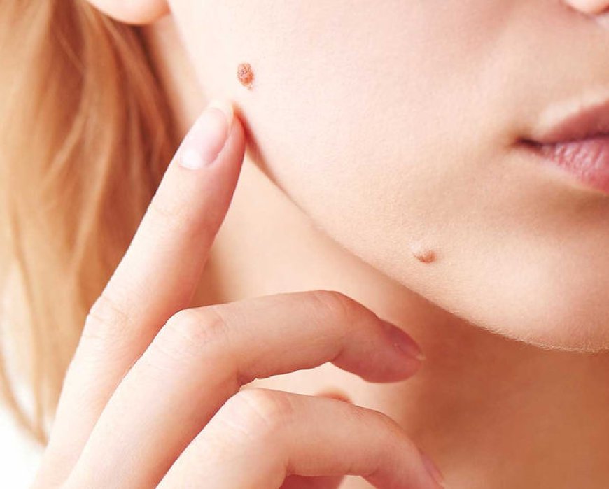 Skin Tag Removal for Sensitive Skin: Best Practices in Dubai