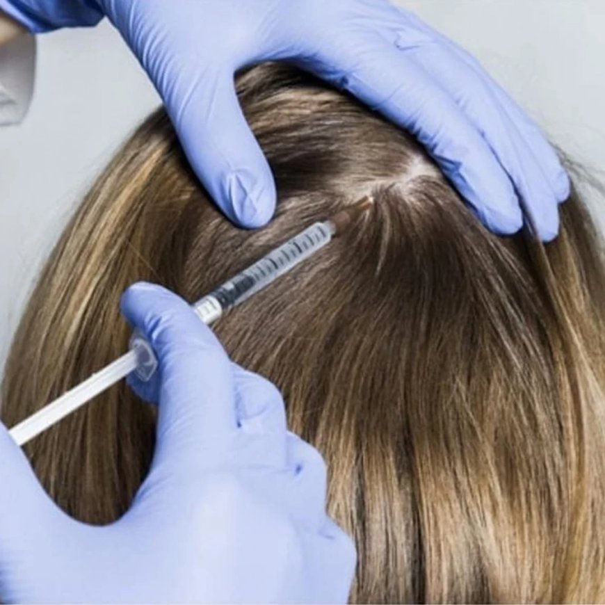 Hair Plasma Therapy and Alopecia: Can It Help?