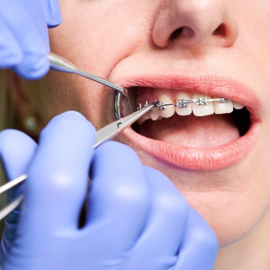 Your Guide to Finding the Most Affordable Dental Braces in Dubai