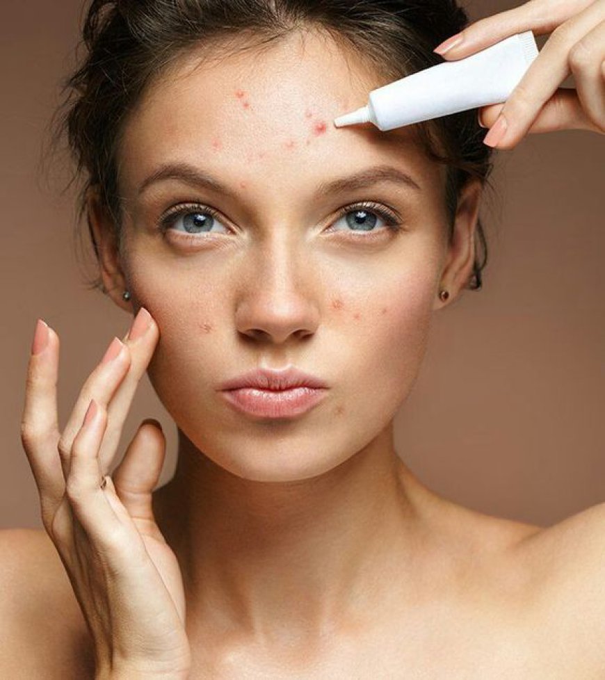 The Hidden Benefits of Proper Acne Scars Treatment