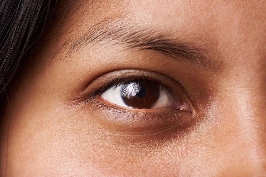 Dark Circles Treatment: Myths and Realities Uncovered