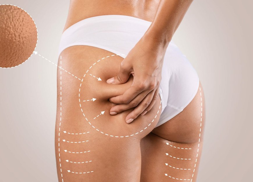 Exploring Brazilian Butt Lift: Risks You Should Know