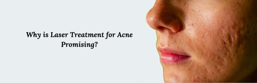 Why is Laser Treatment for Acne Promising?