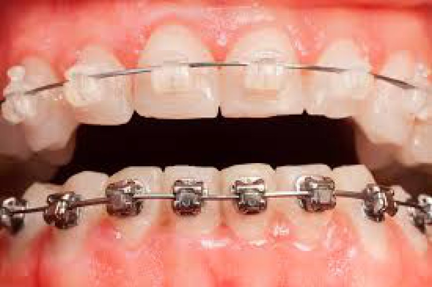 Why Transparent Braces Are Becoming Popular Among Dubai’s Youth