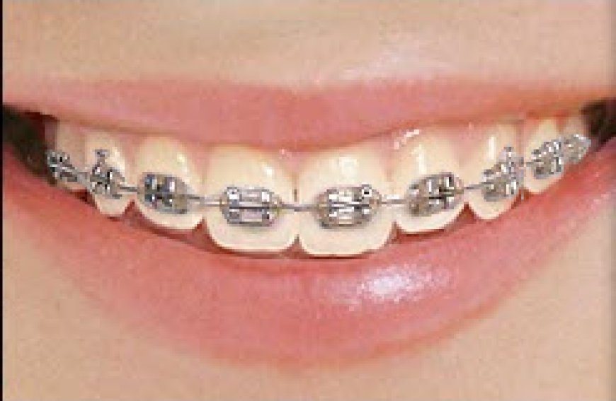 Teeth Braces for Adults: Why It’s Never Too Late for a Perfect Smile