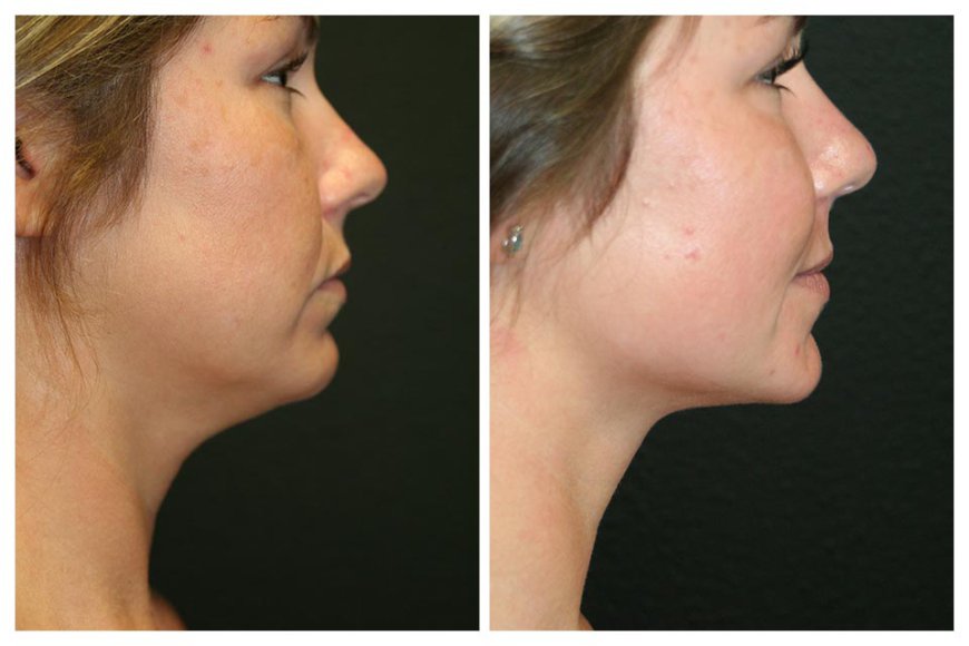 Double Chin Liposuction: An Overview of Techniques and Technologies