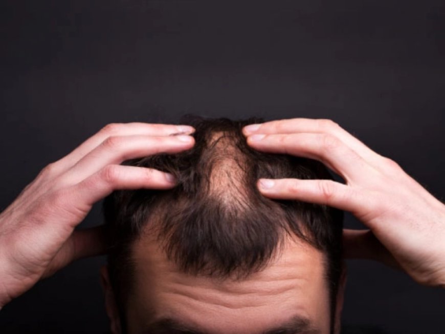 Is Finasteride the Right Solution for Your Hair Loss in Dubai?