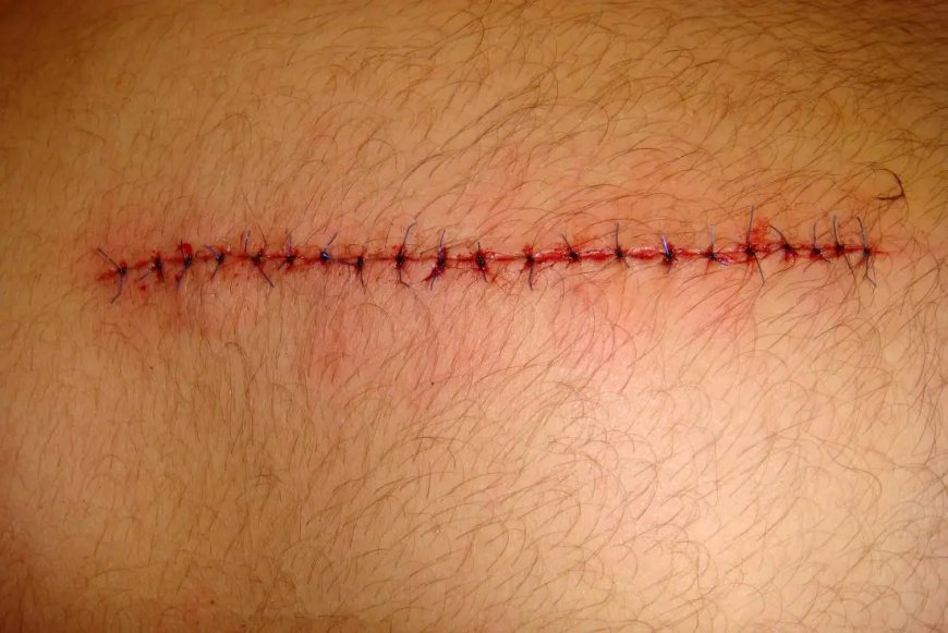 Pain Levels During Stitch Removal: A Comprehensive Guide