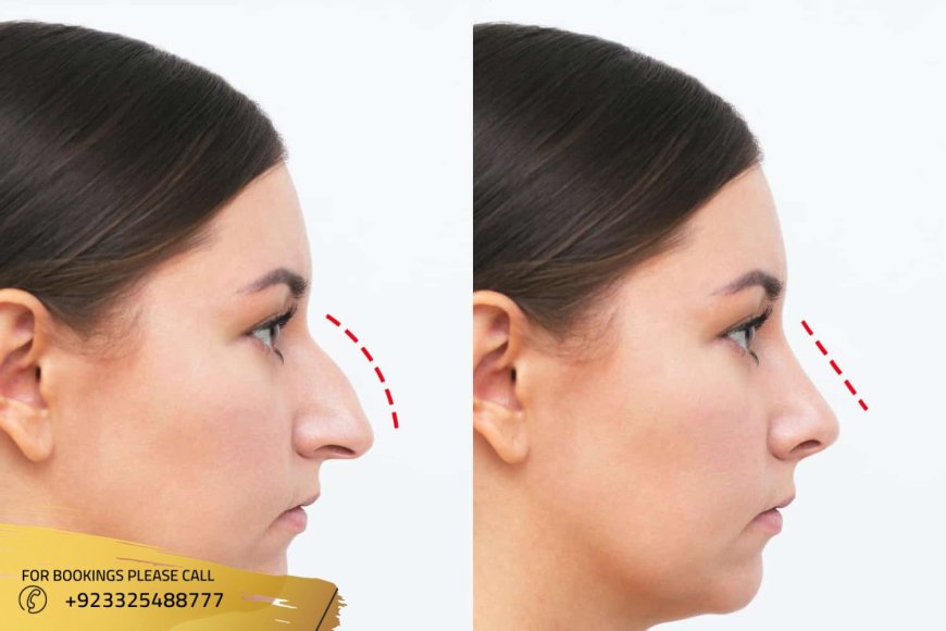 Your Guide to Selecting the Right Rhinoplasty Surgeon in Islamabad