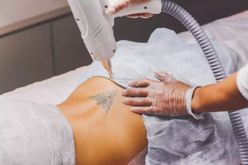 Why Dubai Is a Top Destination for Laser Tattoo Removal