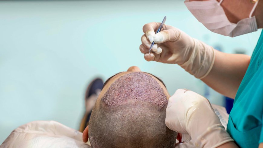 Affordable Hair Transplants in Dubai: Tips for Saving Money