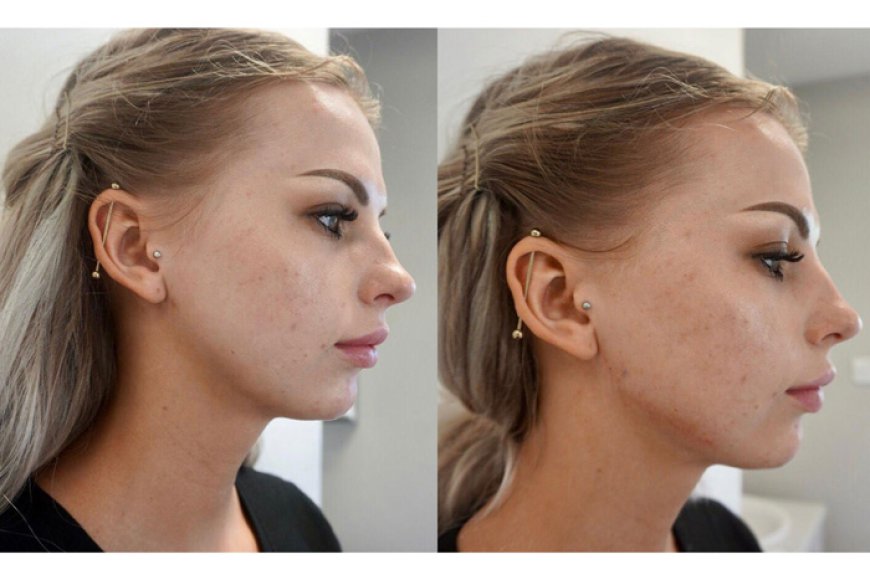 Before and After: Jawline Filler and Cheek Filler Transformations