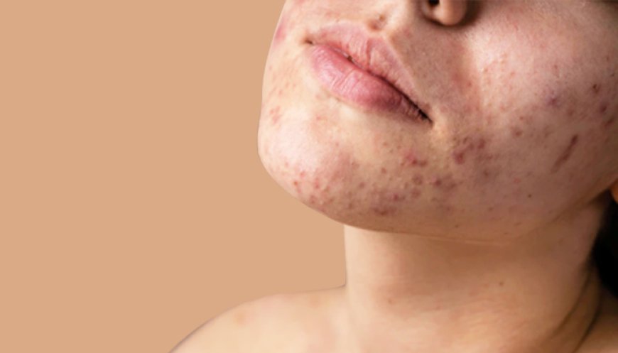 The Ultimate Guide to Pimples Treatment at Home