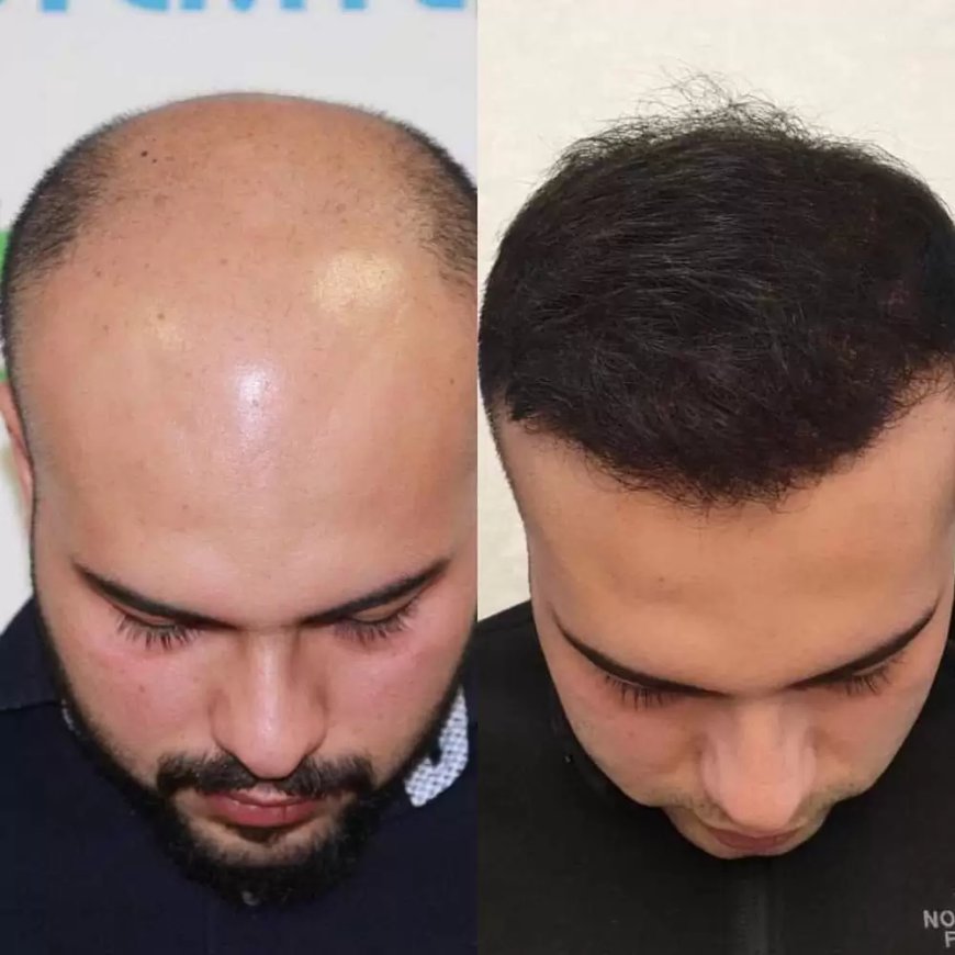 How Much Does a Hair Transplant Procedure Cost Based on Your Hair Type?