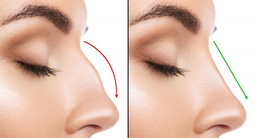 Achieve Balanced Facial Features with Riyadh’s Rhinoplasty Experts