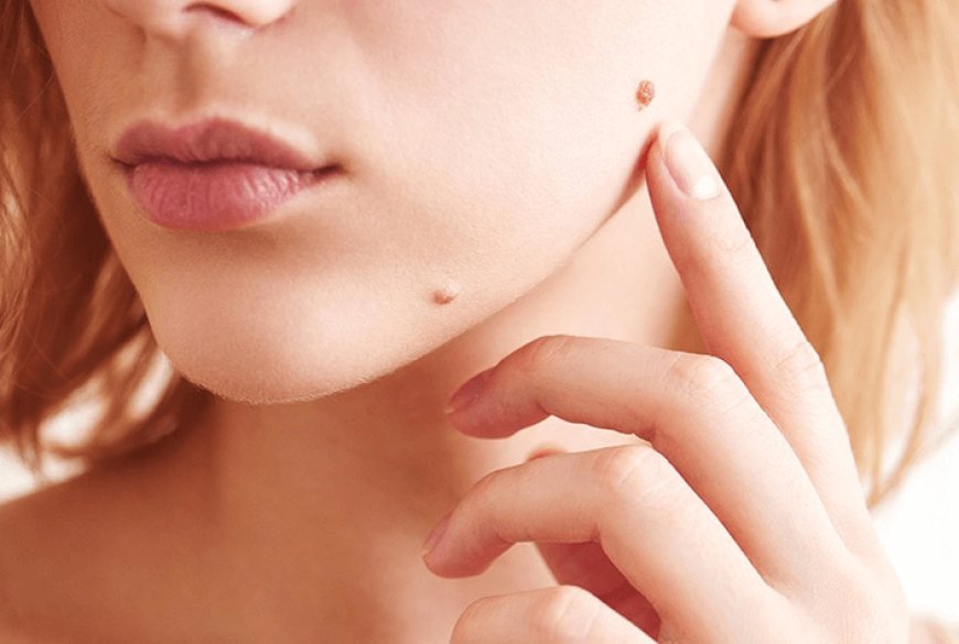 Natural vs. Professional Skin Tag Removal: What Works Best in Dubai?