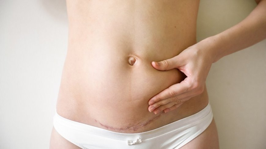 Tummy Tuck in Riyadh: What to Expect Before, During, and After