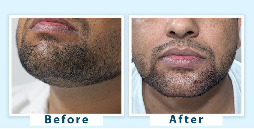 Effective Premature Grey Beard Treatments to Restore Natural Color