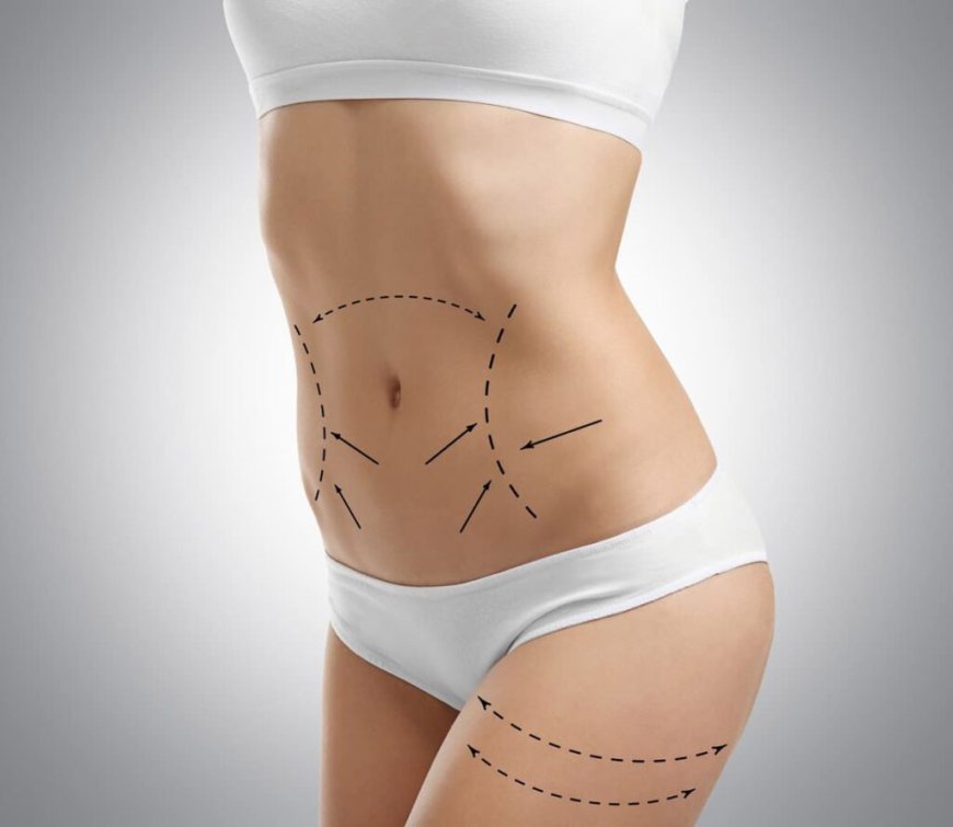 How to Choose the Right Tummy Tuck Technique in Dubai Based on Your Body Type