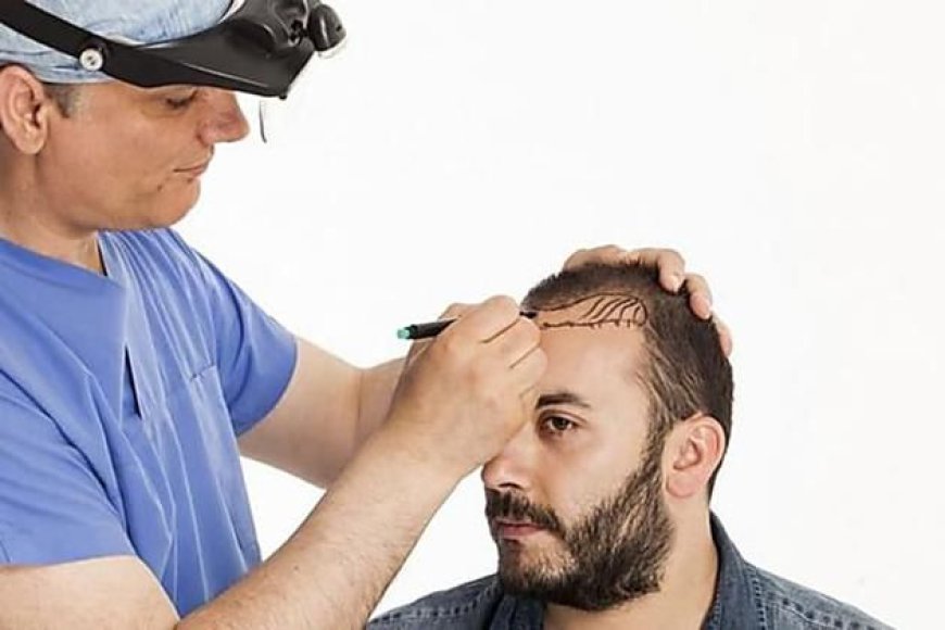 Investigating Non-Surgical Alternatives to Hair Transplants