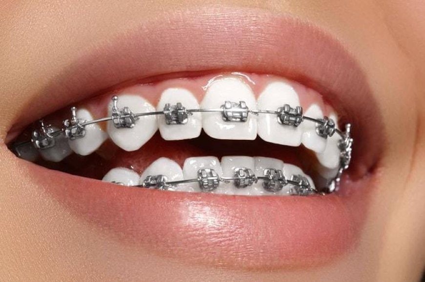 Understanding the Importance of Choosing the Right Teeth Braces