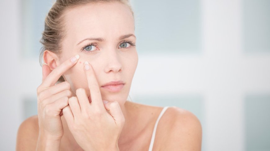 Proven Acne Treatment Strategies for Clearer Skin