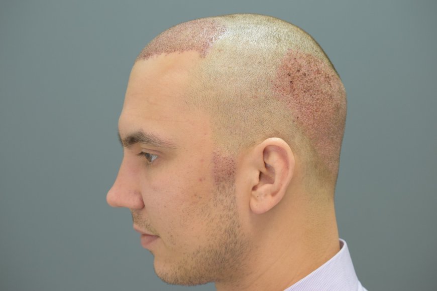 Cost Over Time: Is a Hair Transplant a Long-Term Investment?