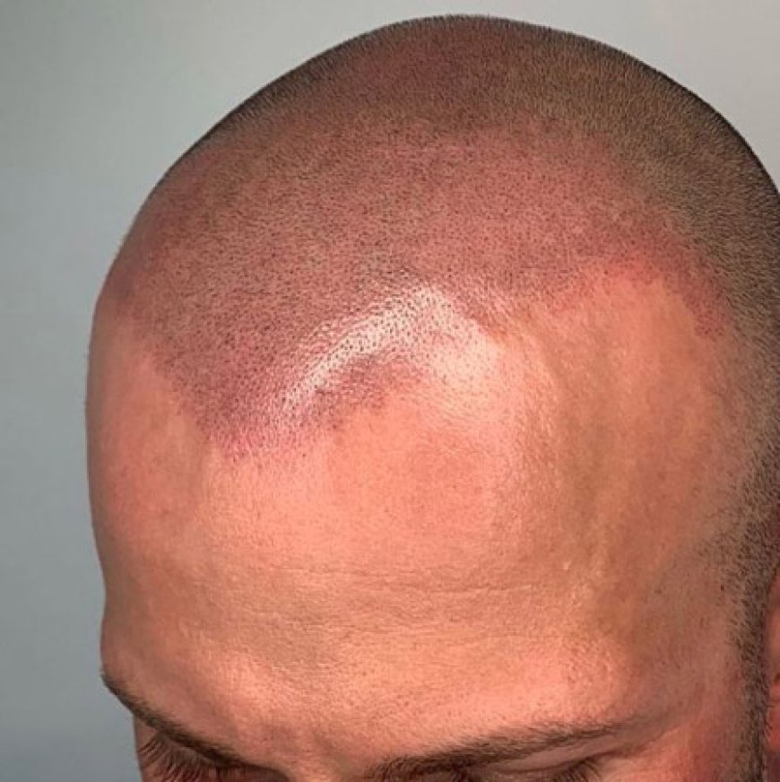 The Art of Scalp Micropigmentation Explained