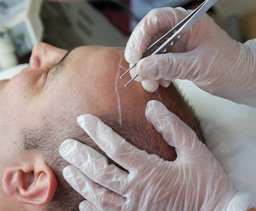 My Experience with Hair Transplant in Riyadh