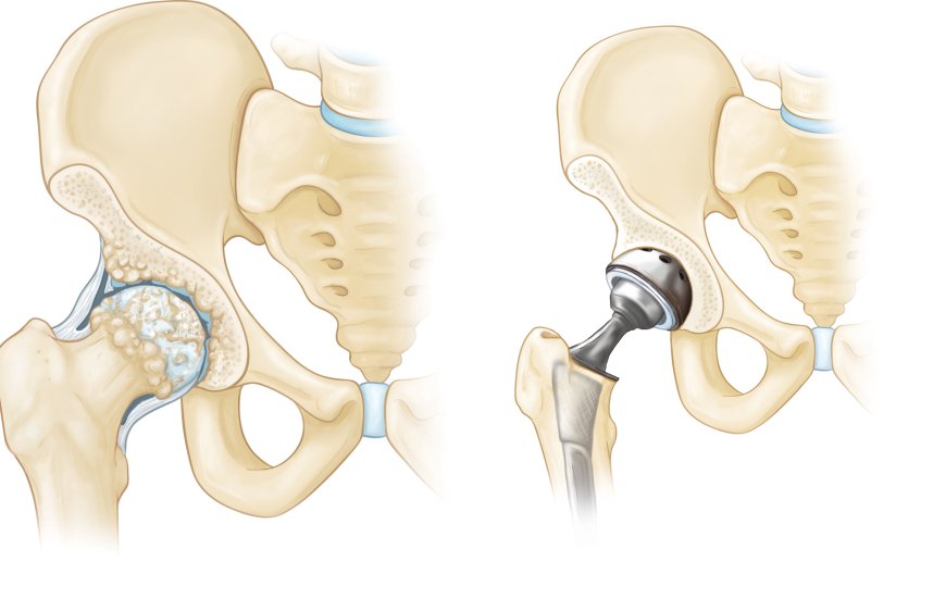 Artificial Hip and Knee Joints Market: Driving Forces and Disruptive Trends [2029]