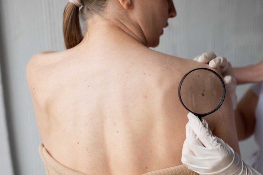 Skin Tag Removal Treatments: Fast, Safe, and Long-Lasting