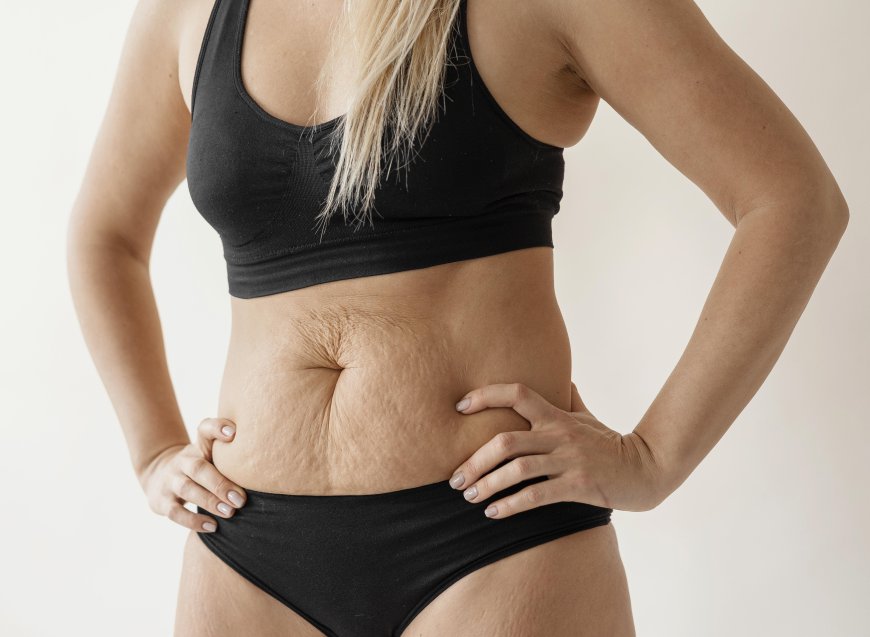 Say Goodbye to Stretch Marks: Top Treatment Centers in Mississauga