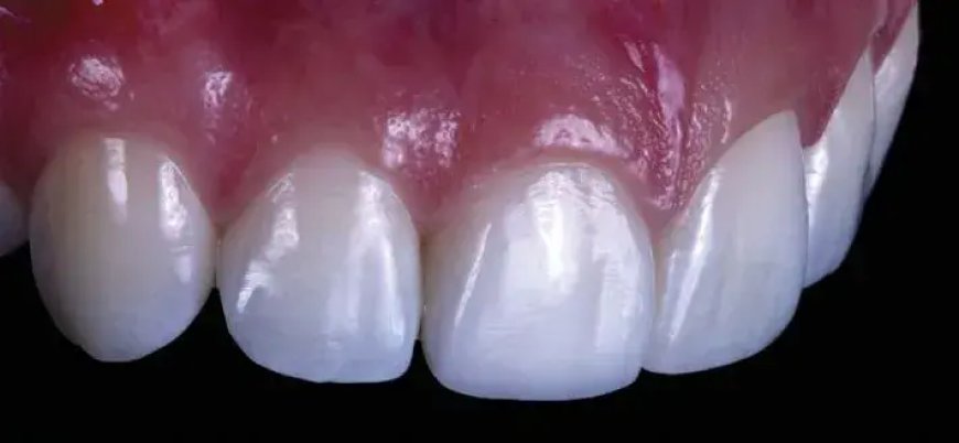 Are Composite Veneers Painful to Apply?