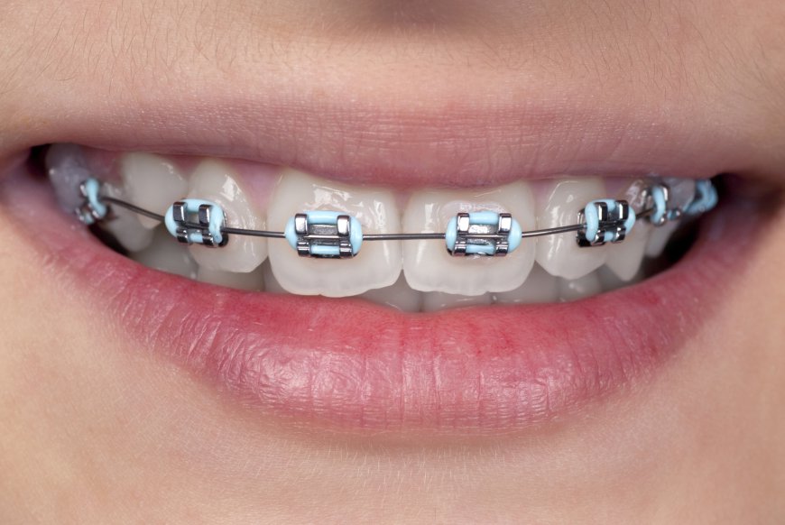 Teeth Braces and Oral Hygiene: Keeping Your Smile Clean During Treatment