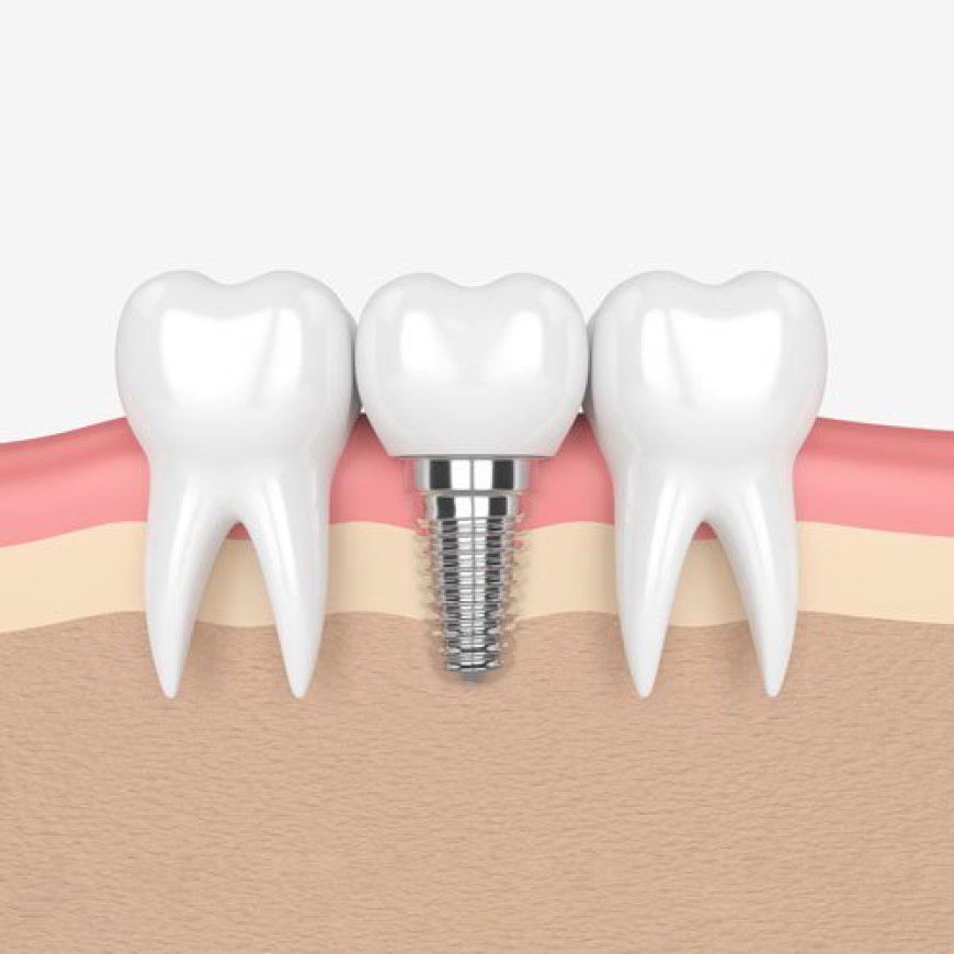 Dental Implants: The Key to a Healthier Mouth