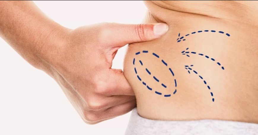 Exploring the Journey From Consultation to Recovery with Best Liposuction Surgeons in Dubai