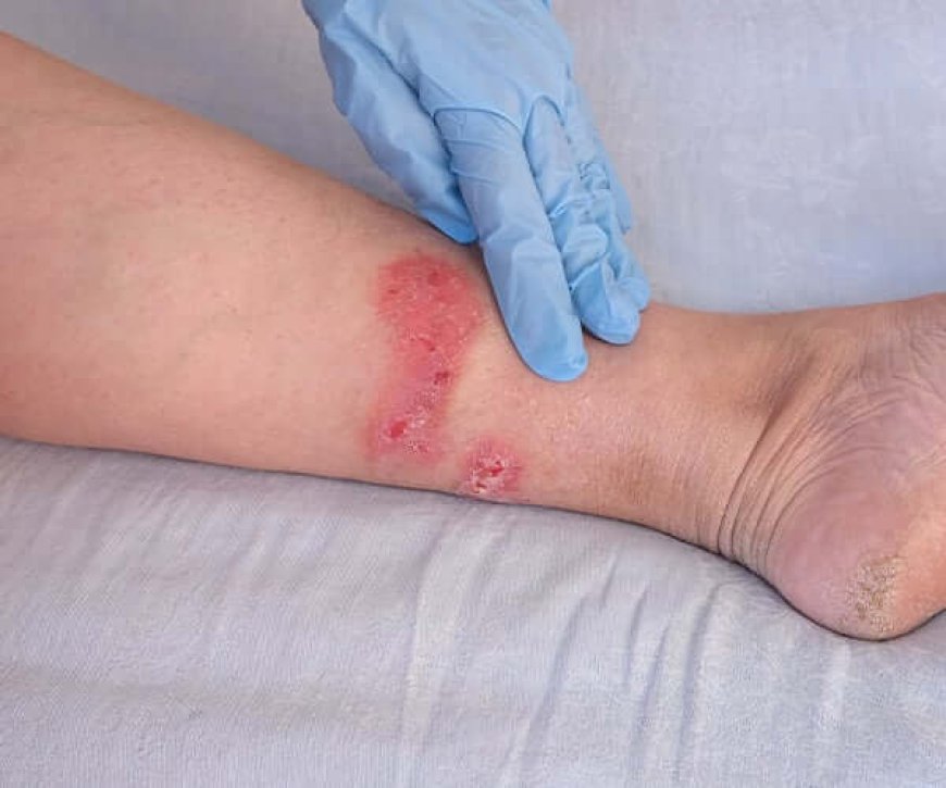 Levofloxacin for Skin Infections