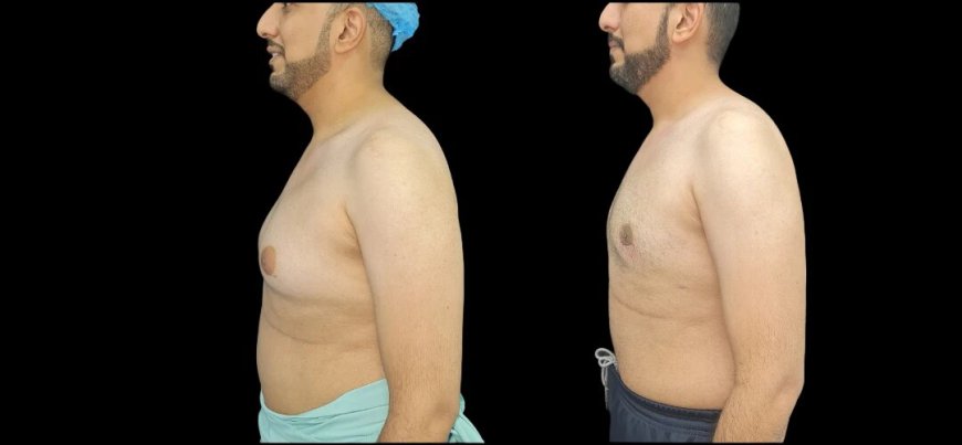 Best Doctors in Dubai: Choosing the Right Surgeon for Gynecomastia Surgery