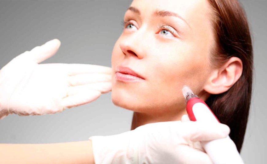 Microneedling Therapy for Face: Transform Your Skin Naturally