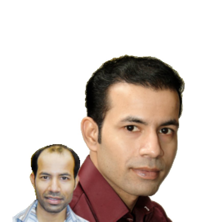 Hair Transplant Cost Comparison between Lahore and Turkey