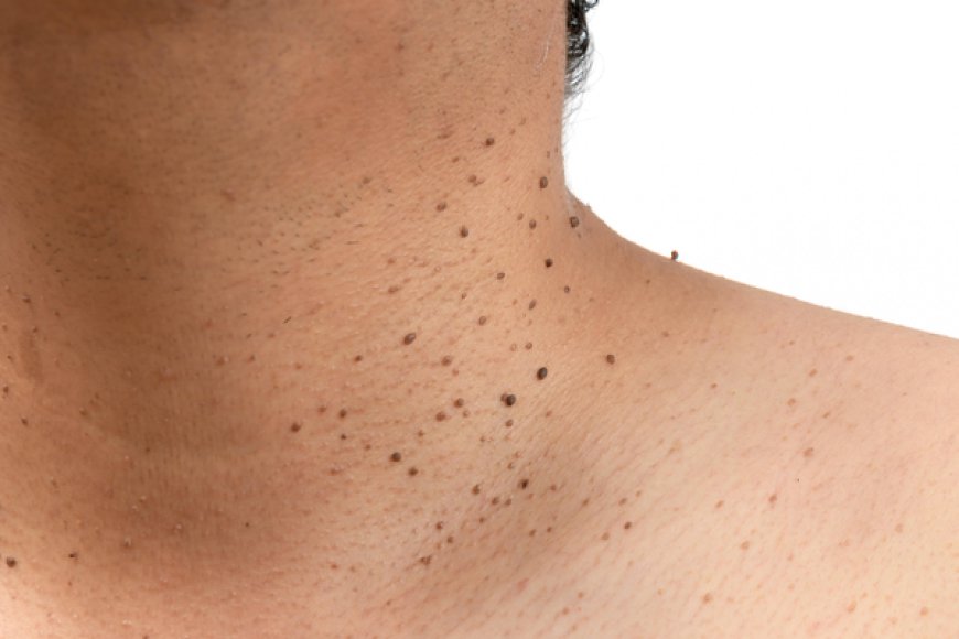 How to prevent skin tags Removal?